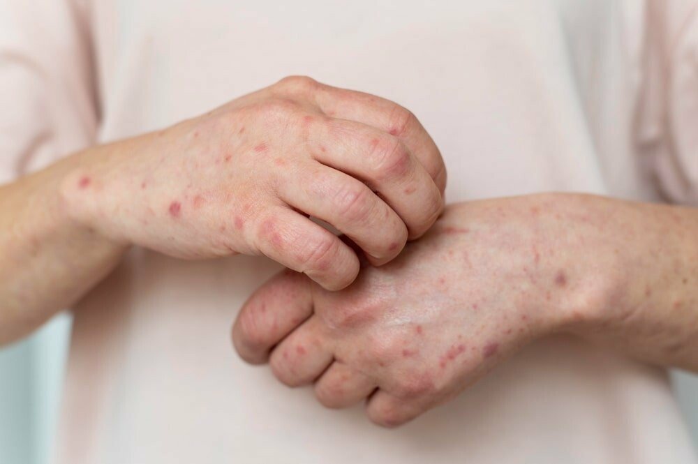 Treponema pallidum: як виявити і лікувати сифіліс вчасно, фото-1